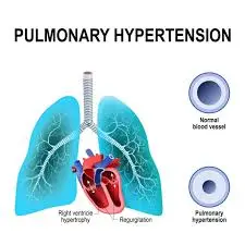 How does Tadalafil work in treating pulmonary hypertension