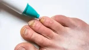 Terbinafine HCl Treating fungal infections