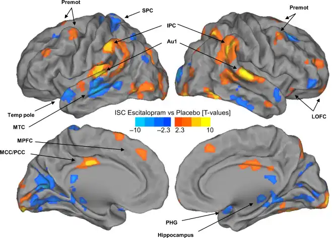 Effect of Escitalopram Effect of Escitalopram