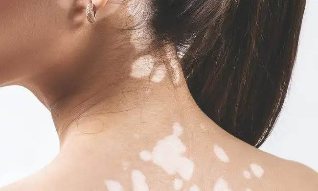 Monobenzone Powder Monobenzone Powder