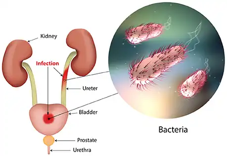 Azithromycin Uti Is Azithromycin Good for UTI? - Salispharm