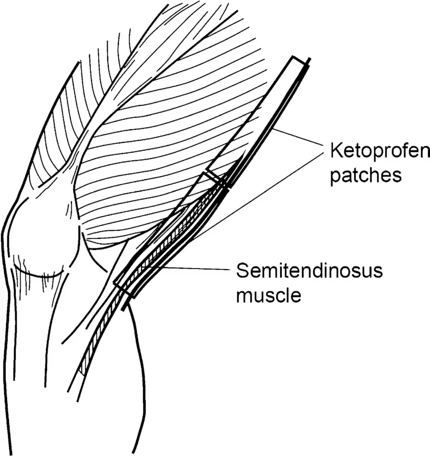 ketoprofen