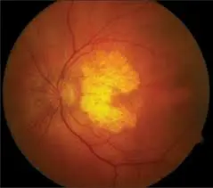 Can zeaxanthin reverse macular degeneration Can zeaxanthin reverse macular degeneration