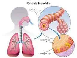 How does guaifenesin work to relieve bronchitis symptoms