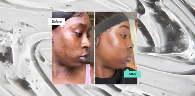 What is the recommended frequency for applying Adapalene powder? What is the recommended frequency for applying Adapalene powder?