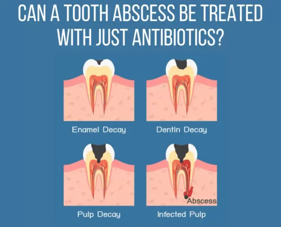 How effective is Amoxicillin for tooth infections?
